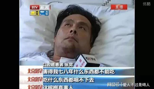 嚼槟榔20年患口腔癌