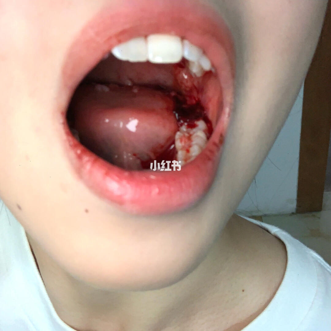 拔智齿后坐飞机爆血