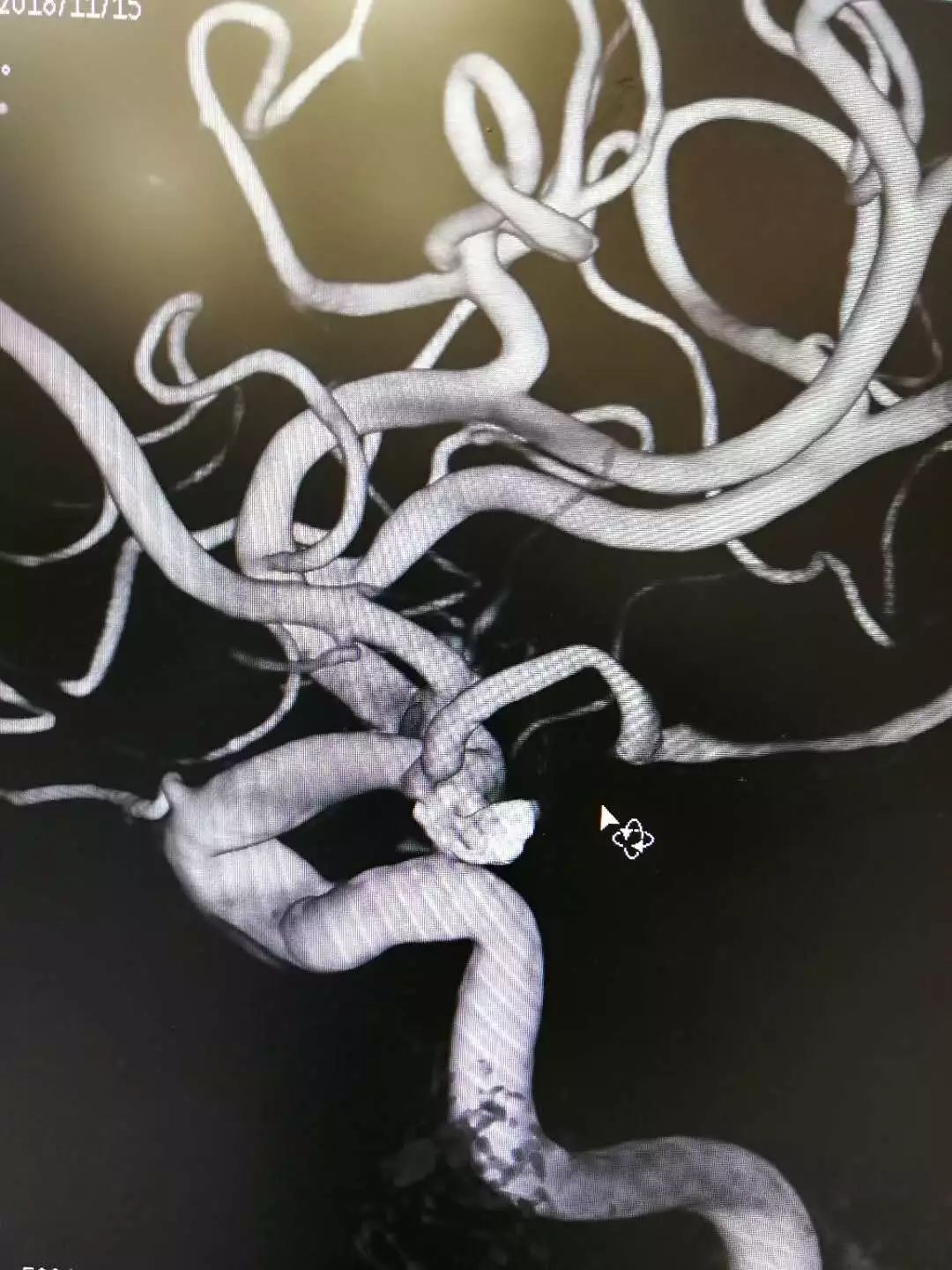 震惊！男子晨起洗澡引发颅内动脉瘤破裂，医生紧急提醒这些致命习惯！